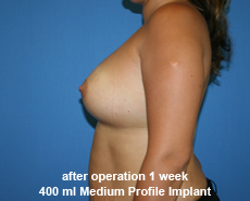 plastic-surgery-breast-augmentation